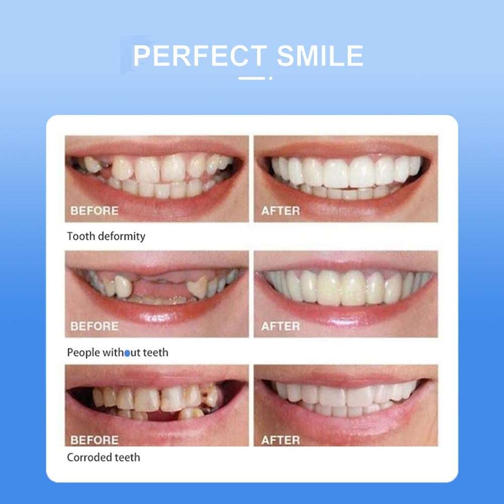 Snap On Smile Braces Teeth Kit - Link Lift Shop