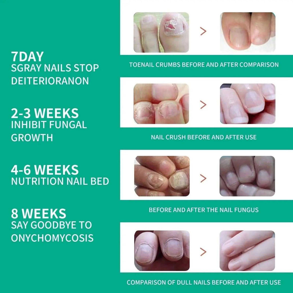 Nail Fungus Serum (MADE IN USA) - Link Lift Shop